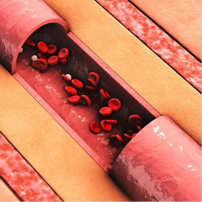 Blood Flow Optimization